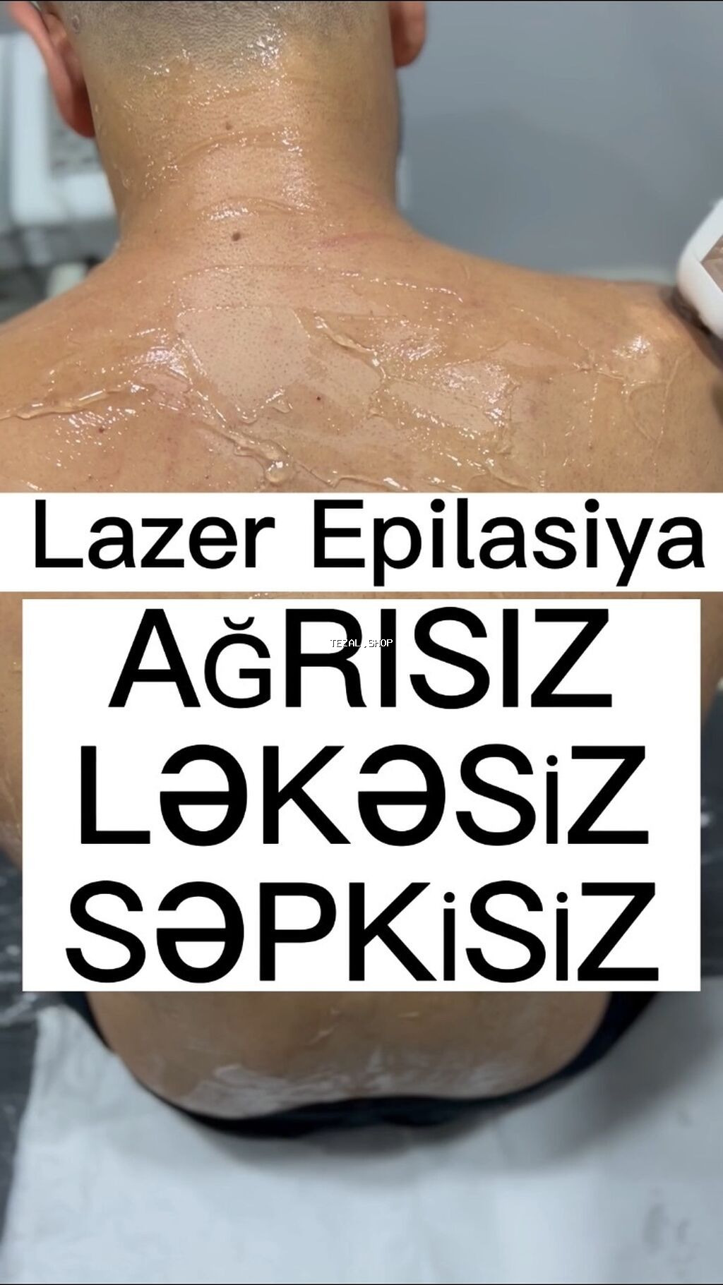 💥Kişilər üçün Lazer Epilasiya💥 Üz,Boyun,Boğaz,Qulaq,Burun = 15 AZN - şəkil 2
