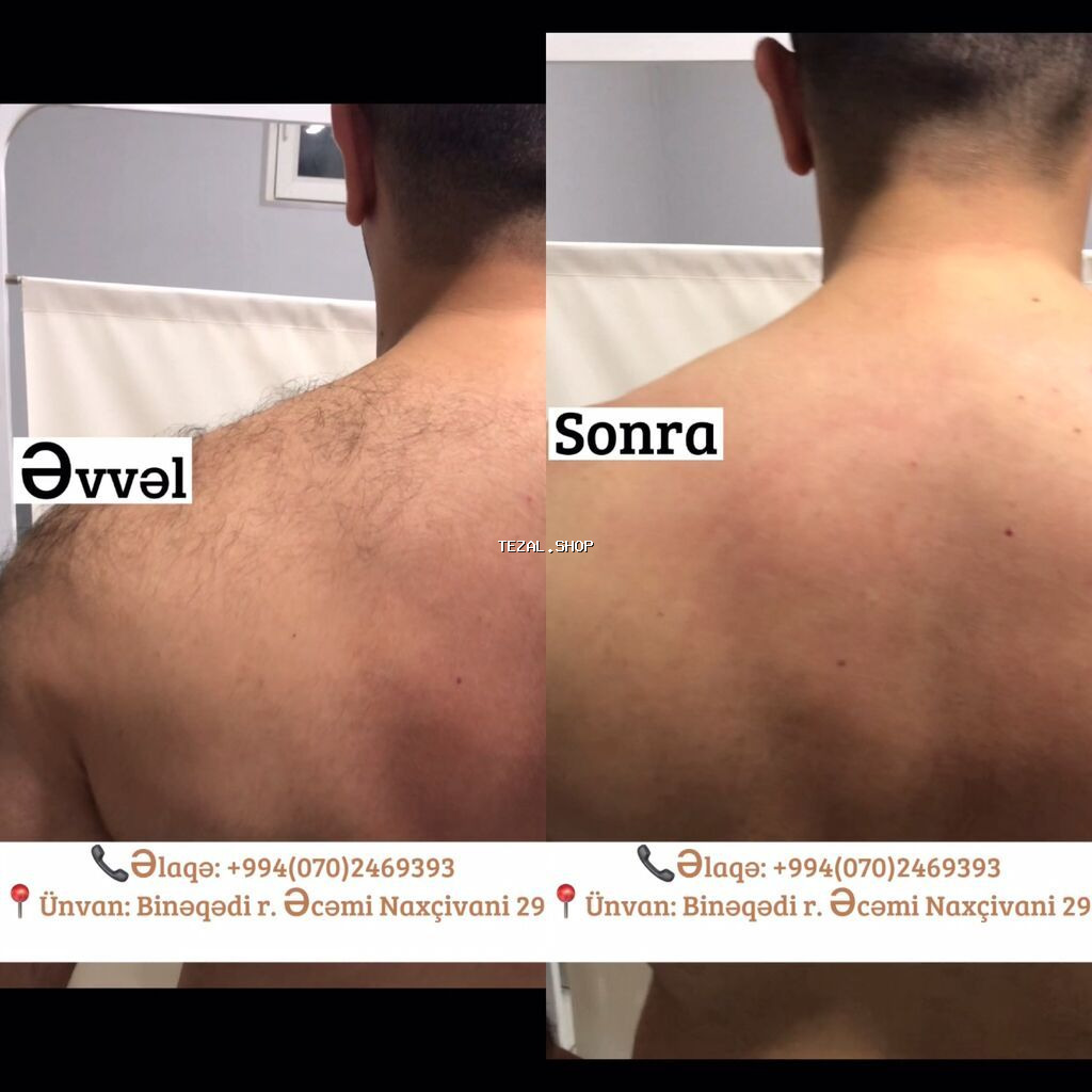 💥Kişilər üçün Lazer Epilasiya💥 Üz,Boyun,Boğaz,Qulaq,Burun = 15 AZN - şəkil 4