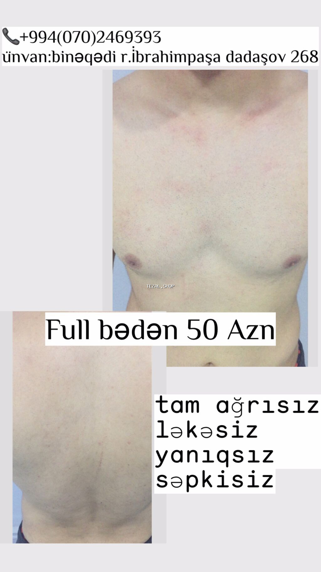 💥Kişilər üçün Lazer Epilasiya💥 Üz,Boyun,Boğaz,Qulaq,Burun = 15 AZN - şəkil 5