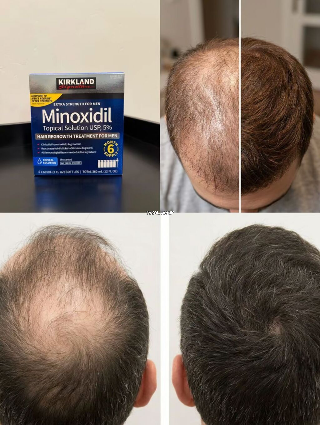 🔥 Kirkland Minoxidil 5% (60 ml) — 💯 ABŞ-dan ORİJİNAL (Costco) 🚨 VACİB - şəkil 2